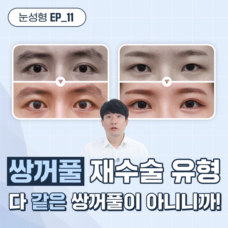 눈재수술 환자 유형별 후기 (비대칭 쌍꺼풀, 소세지 쌍꺼풀)