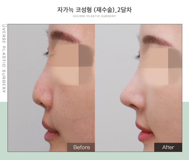 [Real Case] Autologous Rib Cartilage Rhinoplasty (Revision), Deviated Nose, Short Nose
