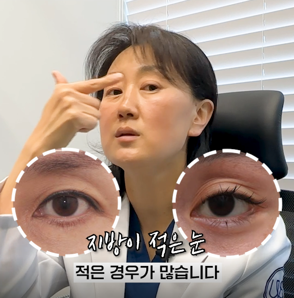 두꺼운 눈두덩이 "눈재수술에 좋은 이유"