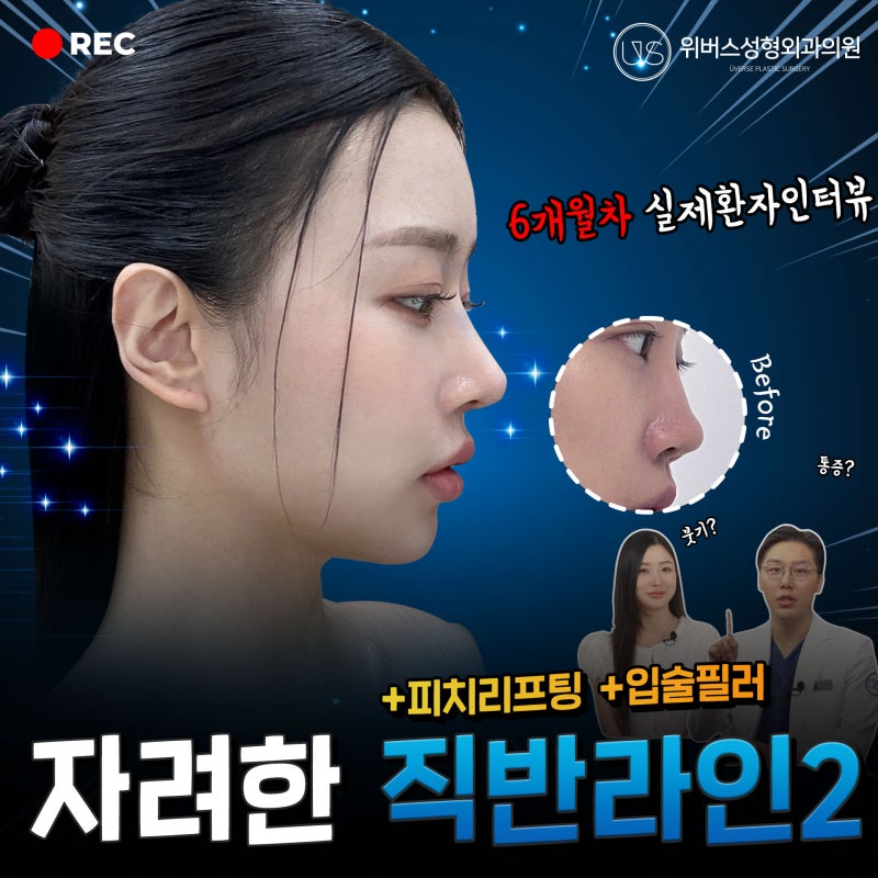 自然华丽的直微翘鼻整形第2篇!(真实模特 & Seo Seung-jo院长的6个月术后采访!!)
