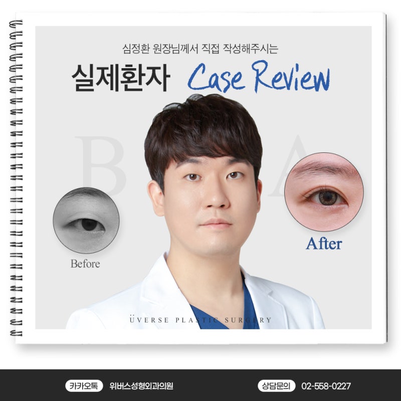 절개 쌍꺼풀+눈매교정+앞트임+눈두덩이 지방제거 실제 케이스 리뷰